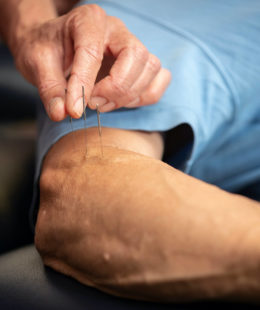 dry needling physiotherapy